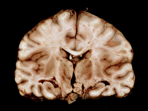 2A3 Meningitis, Strep pneu (Case 2) 17