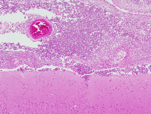 2B2 Meningitis, Strep pneu (Case 2) 2A