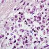 2C Meningitis, septicemia, mycotic aneurysm, microabscesses (Case 2) Gram 3 copy