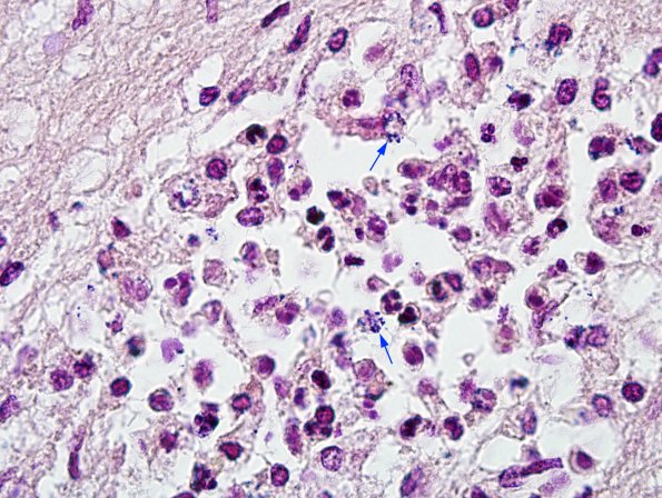 2C Meningitis, septicemia, mycotic aneurysm, microabscesses (Case 2) Gram 3 copy