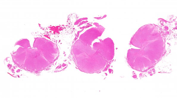 2D1 Meningitis, Strep pneu (Case 2) H&E whole mount 3