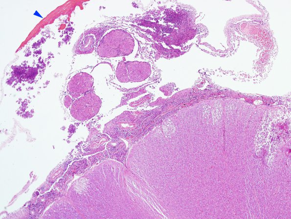 2D3 Meningitis, Strep pneu (Case 2) H&E 11 copy