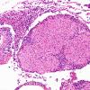 2E1 Meningitis, Strep pneu (Case 2) H&E 12