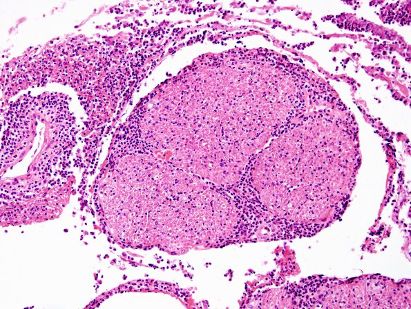 2E1 Meningitis, Strep pneu (Case 2) H&E 12