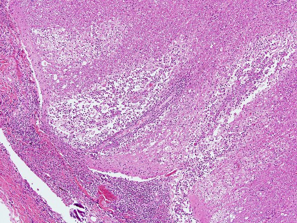 2E2 Meningitis, Strep pneu (Case 2) H&E 7