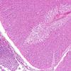 2E3 Meningitis, Strep pneumoniae (Case 2) H&E 5A