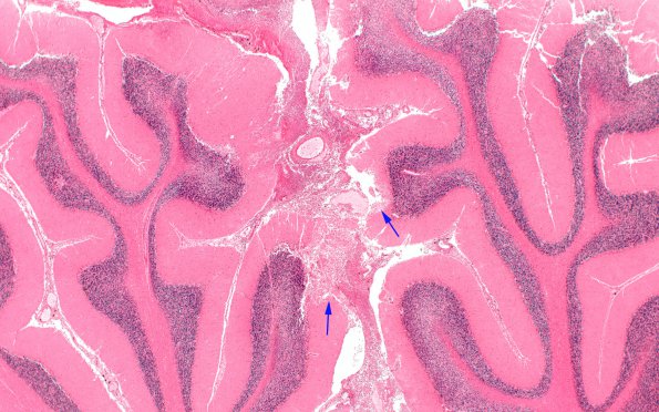 2F Meningitis, Strep pneu N15 (Case 2) H&E 1 copy