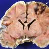 3A2 Meningitis 4b thrombophlebitis (Case 3) 4 copy