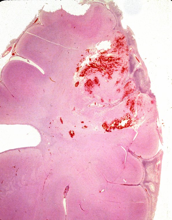 3A3 Meningitis 4e , thrombophlebitis (Case 3) 6