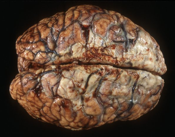 4A1 Meningitis, bacterial (Case 4) Gross 8