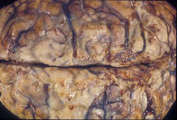 4A2 Meningitis, PC & Infarcts (Case 4) 1