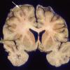 4A3 Meningitis, PC & Infarcts (Case 4) 3 copy