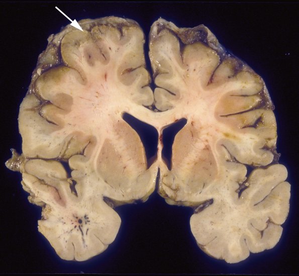 4A3 Meningitis, PC & Infarcts (Case 4) 3 copy