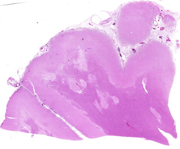 4B1 Meningitis, bacterial (Case 4) N12 H&E 4