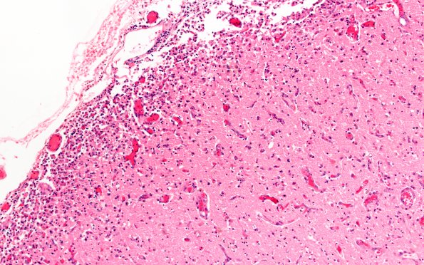 4B2 Meningitis, bacterial (Case 4) N12 H&E 2