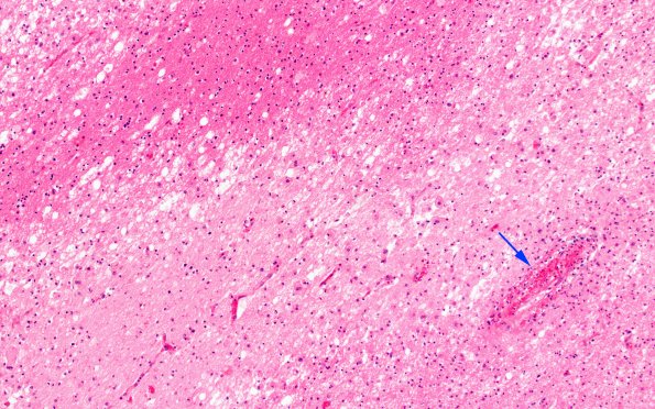 4B3 Meningitis, bacterial (Case 4) N12 H&E 3 copy