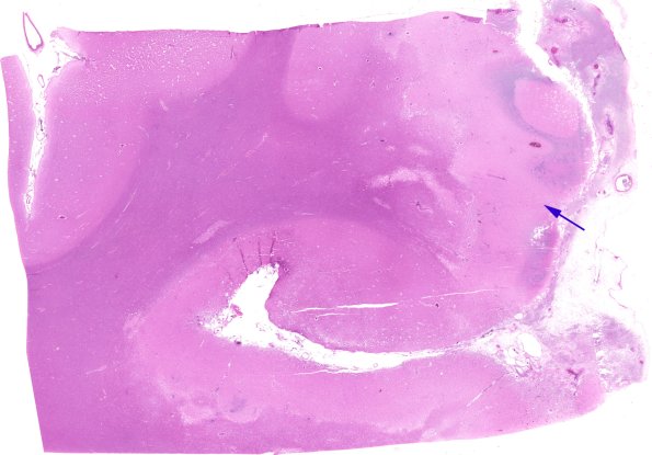 4B4 Meningitis, bacterial (Case 4) N1 H&E 2 copy