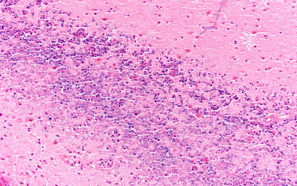 4B5 Meningitis, bacterial (Case 4) N1 3