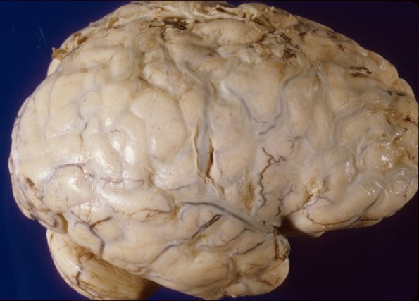 5A1 Meningitis, bacterial (Case 5) PC 4