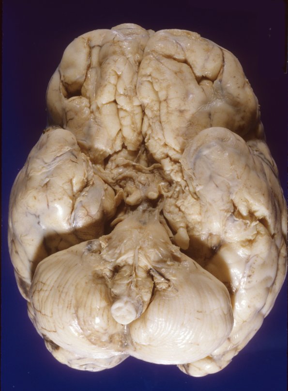 5A2 Meningitis, bacterial (Case 5) PC 5