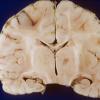 5A3 Meningitis, bacterial (Case 5) PC 2