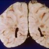 5A4 Meningitis, bacterial (Case 5) PC 3