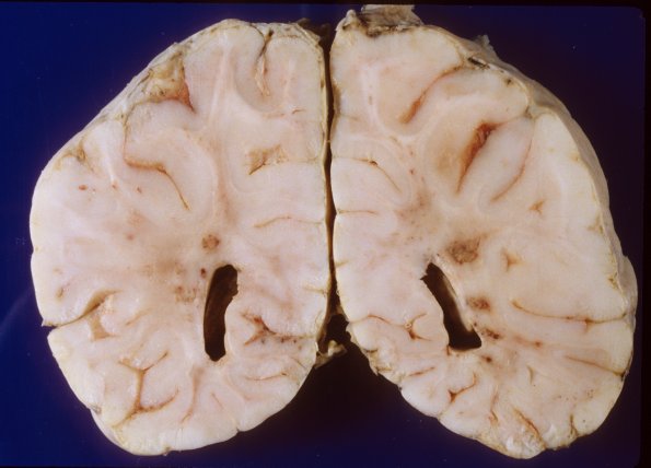 5A4 Meningitis, bacterial (Case 5) PC 3