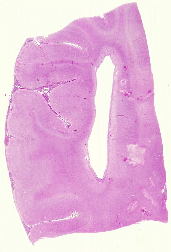 5B1 Infarcts, neonatal, periventricular (Case 5) 2 H&E whole mount