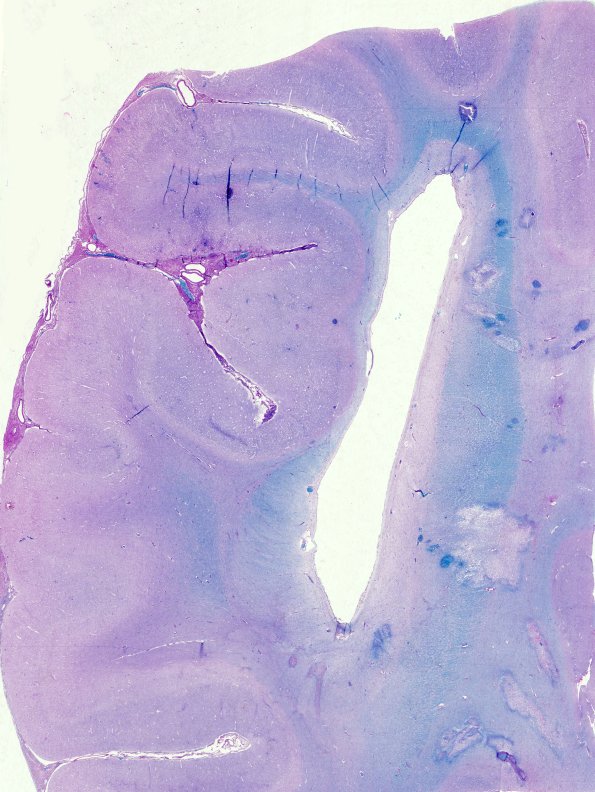 5B2 Infarcts, neonatal, periventricular (Case 5) 2 LFB-PAS whole mount