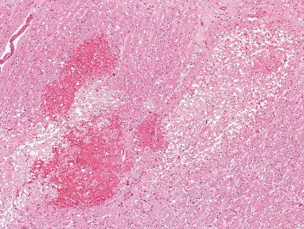 5B3 Infarcts, neonatal, periventricular (Case 5) 1 H&E 2