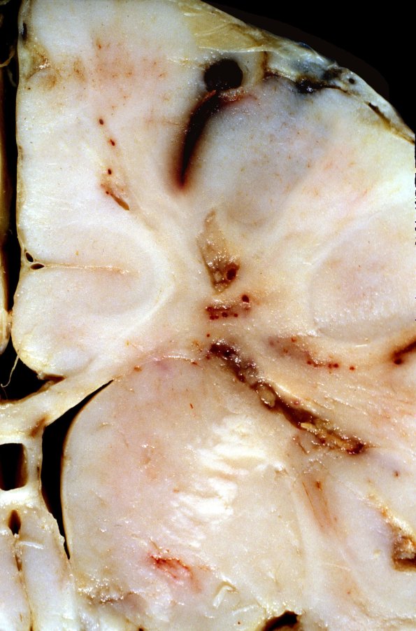 5C Meningitis 4d, thrombophlebitis (Case 5) 2