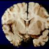 6A1 Meningitis, bacterial (Case 6) PC A13