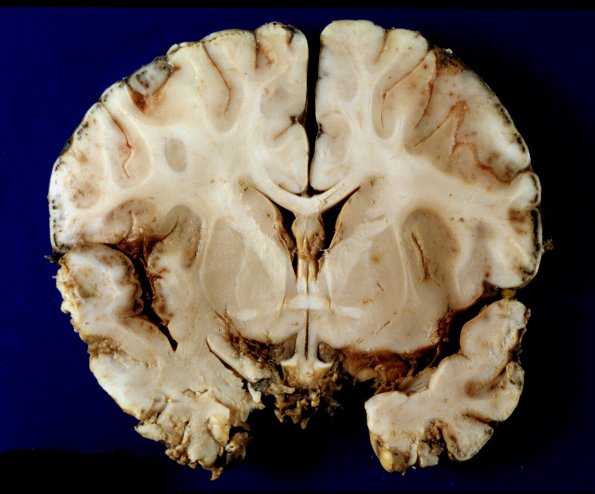 6A1 Meningitis, bacterial (Case 6) PC A13