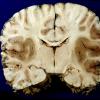 6A2 Meningitis, bacterial (Case 6) PC A12