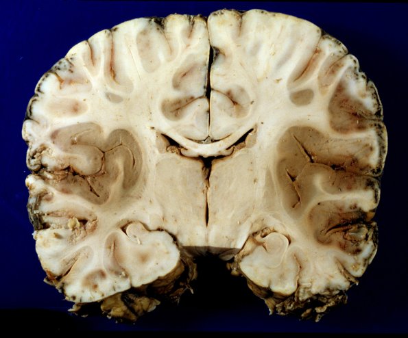 6A2 Meningitis, bacterial (Case 6) PC A12