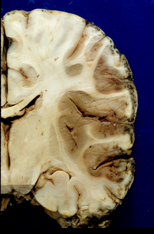 6A3 Meningitis, bacterial (Case 6) PC A8