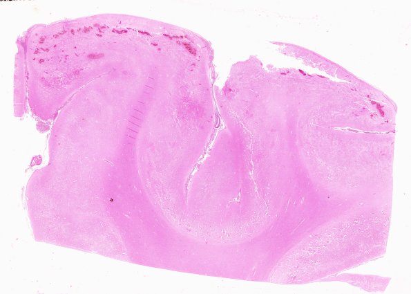 6B1 Meningitis, bacterial (Case 6) H&E I 2