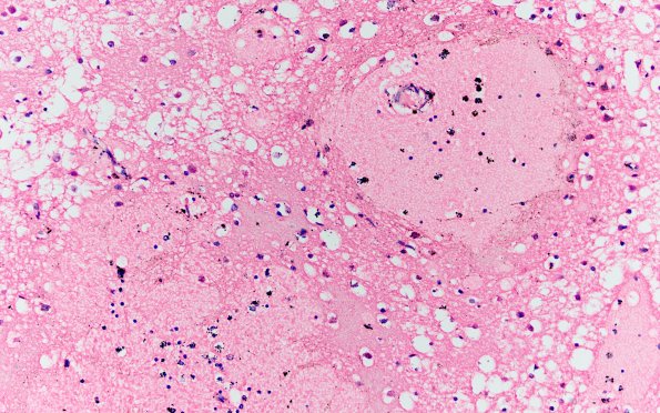 6B2 Meningitis, bacterial (Case 6) H&E A 7