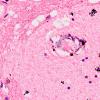 6B3 Meningitis, bacterial (Case 6) H&E A 8