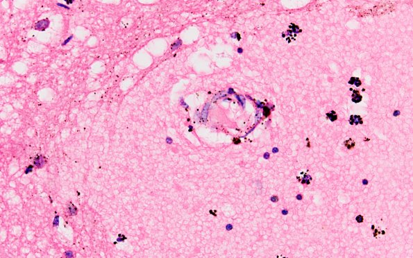 6B3 Meningitis, bacterial (Case 6) H&E A 8