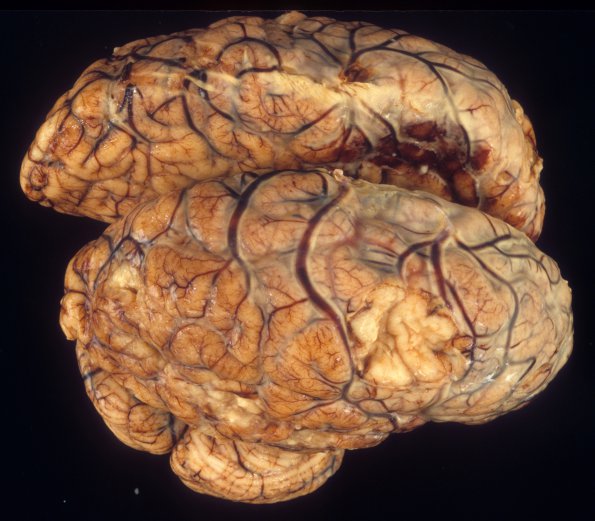 7A1 Meningitis, STR (Case 7) 2