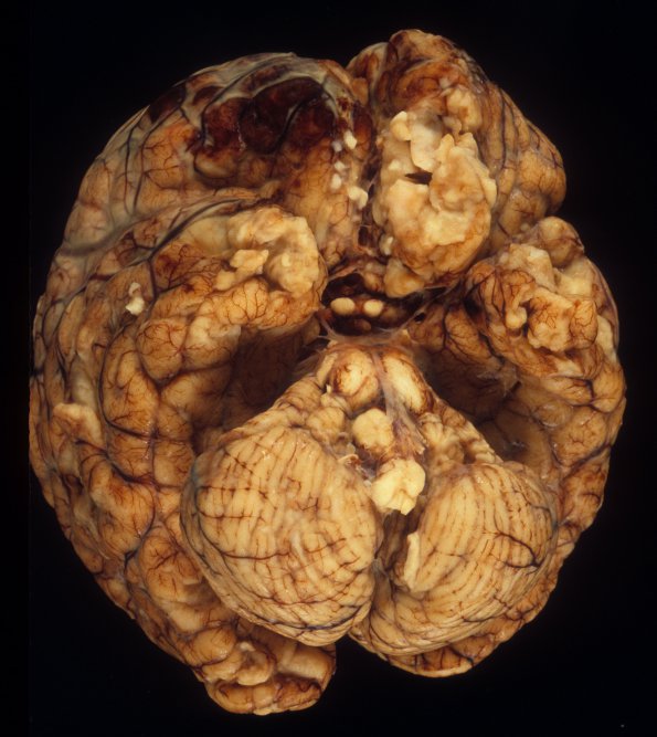 7A2 Meningitis, STR (Case 7) 1