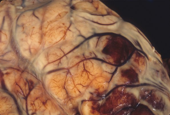 7A3 Meningitis, STR (Case 7) 3