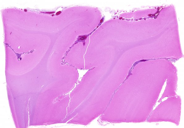 7B1 Meningitis, STR (Case 7) N5 H&E 1