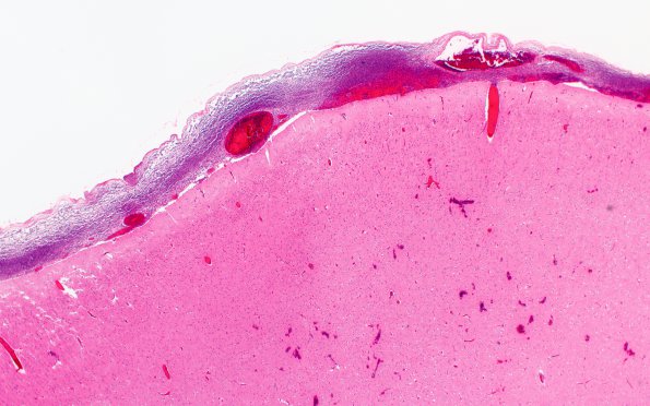 7B2 Meningitis, STR (Case 7) N1 2