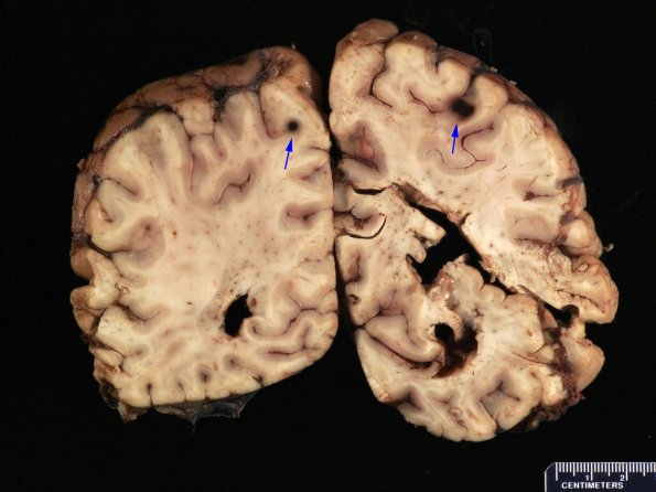 9A Meningitis, septicemia, mycotic aneurysm, microabscesses (Case 9) Gross _8 copy