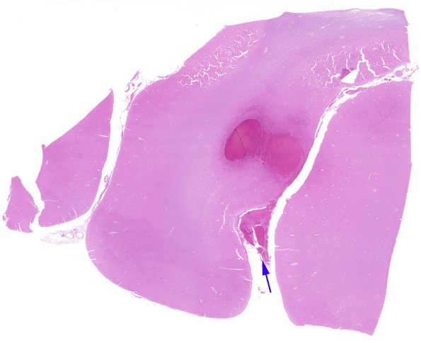 9B1 Meningitis, septicemia, mycotic aneurysm, microabscesses (Case 9) H&E whole mount copy