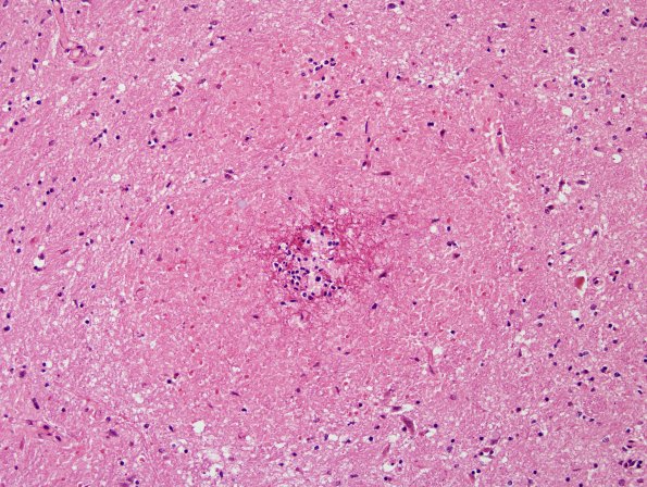 9B2 Meningitis, septicemia, mycotic aneurysm, microabscesses (Case 9) H&E 8