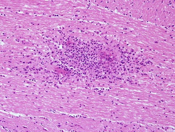 9B3 Meningitis, septicemia, mycotic aneurysm, microabscesses (Case 9) H&E 1B