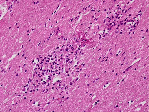 9B4 Meningitis, septicemia, mycotic aneurysm, microabscesses (Case 9) H&E 2